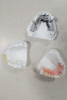 Long Lasting Flexible Removable Partial Denture Easy Cleaning Replace Missing Teeth